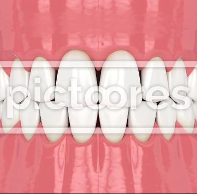 Human jaw with open gingival embrasure