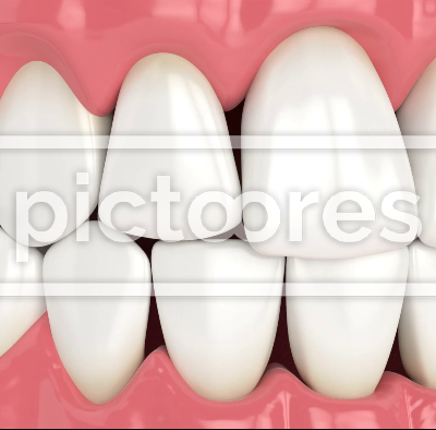 Human jaw with open gingival embrasure
