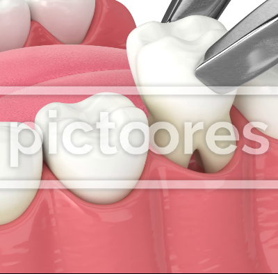 Jaw bone recession after tooth extraction