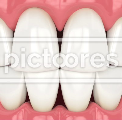 Human jaw with black triangles spaces between teeth