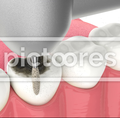 Lower jaw with treatment of tooth decay using filling crown