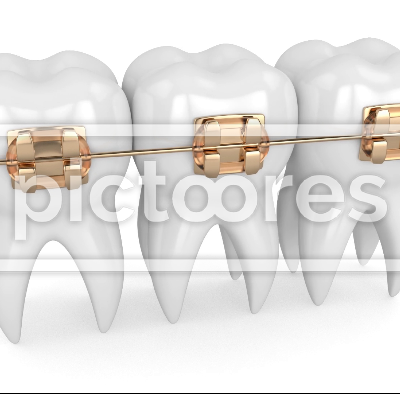 Teeth with golden orthodontic braces