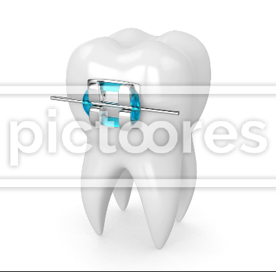 Tooth with dental orthodontic braces