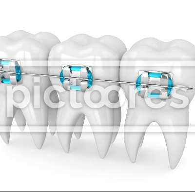 Teeth with dental orthodontic braces