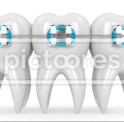 Teeth with dental orthodontic braces