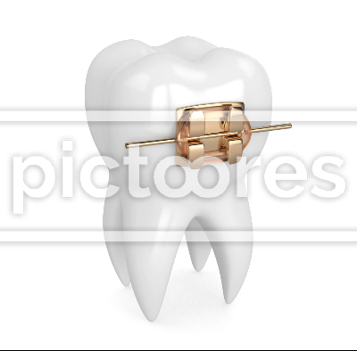 Tooth with golden orthodontic brace