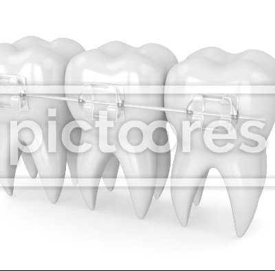 Teeth with clear orthodontic braces