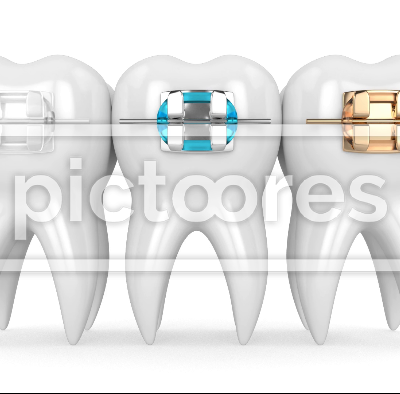 Teeth with three types of orthodontic braces