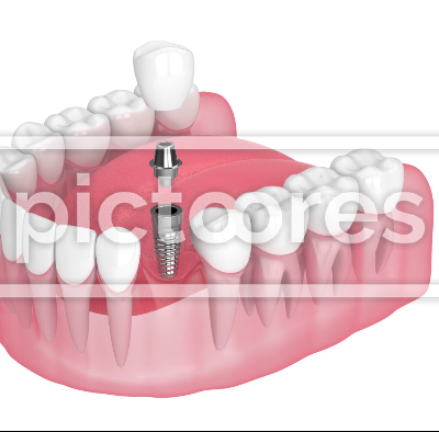 Dental implant placement