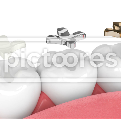 Teeth in jaw with three different types of dental inlay filling