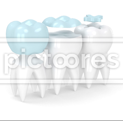 Teeth in jaw with three different types of dental filling