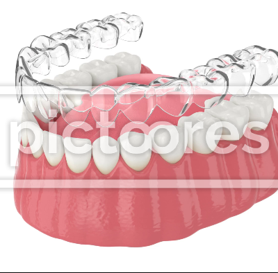 Clear removable aligner placement on lower jaw