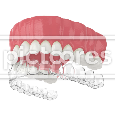 Clear removable aligner placement on upper jaw