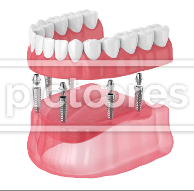 Removable full implant denture