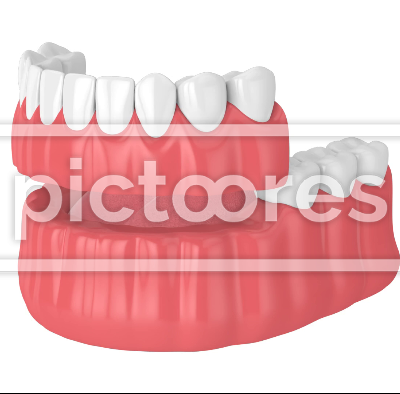 Partial denture mounted on the lower jaw arch