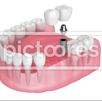 Jaw with implant supported dental cantilever bridge