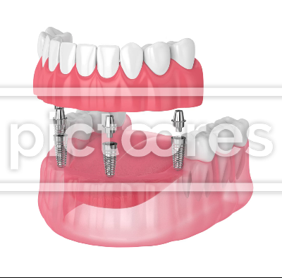 Partial denture bolted by implants
