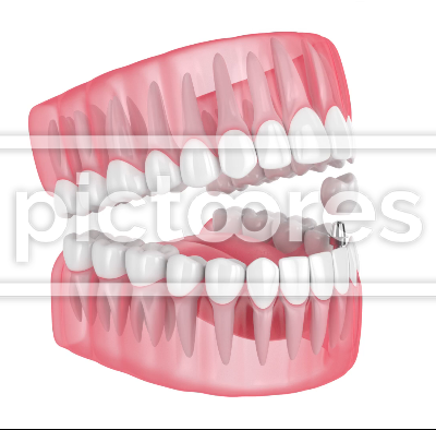 Jaw with dental implant placement