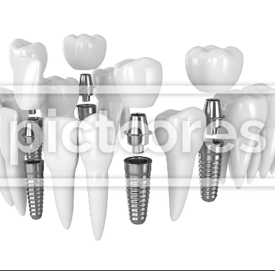 Toothing with dental implants