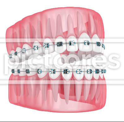 Jaw with teeth and stainless steel orthodontic braces