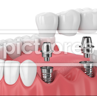 Jaw with implants supporting dental bridge