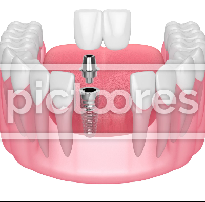 Jaw with implant supported dental cantilever bridge