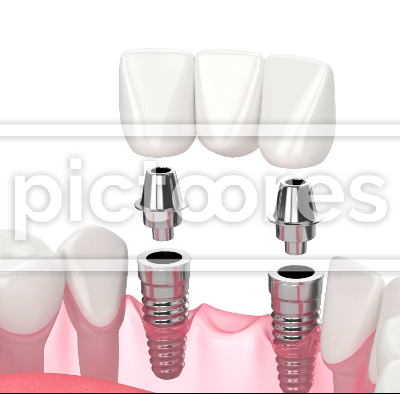 Jaw with implants supporting dental bridge