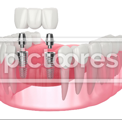 Jaw with implants supporting dental bridge