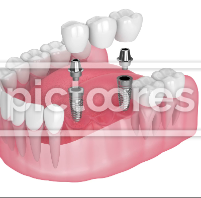 Jaw with implants supporting dental bridge