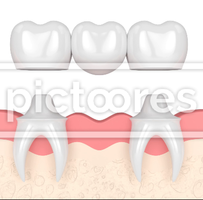 Gums with dental molar bridge over white