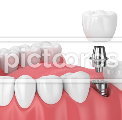 Jaw with dental implant placement
