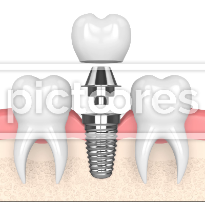 Dental implant placement over white background
