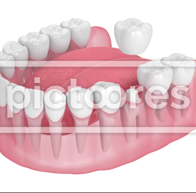 Jaw with dental crown embed on reshaped tooth