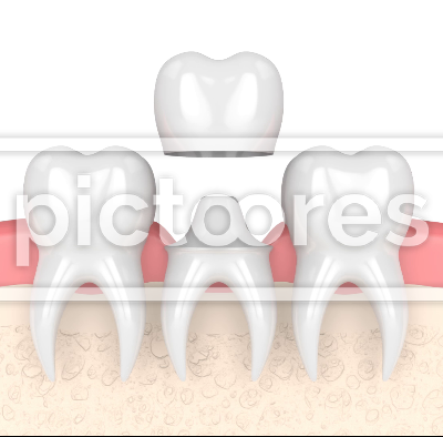 Gums with dental composite crown filling