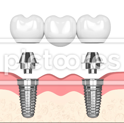 Implants supporting dental bridge