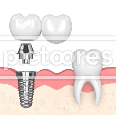Gums with implant supported dental cantilever bridge