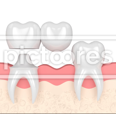 Gums with supported dental cantilever bridge