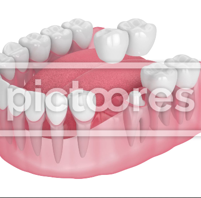 Jaw with dental cantilever bridge