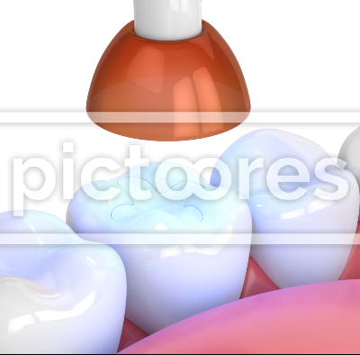 Jaw with dental polymerization lamp and light cured inlay filling