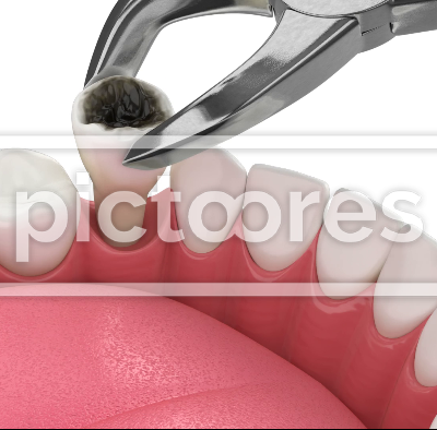 Tooth extraction and dental implant installation