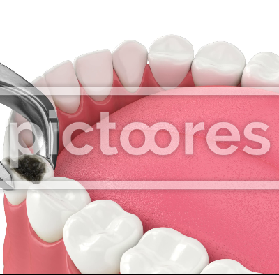 Tooth extraction by dental forceps