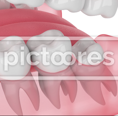 Jaw with mesial impacted wisdom tooth