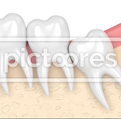 Gums with wisdom tooth mesial causing crowding