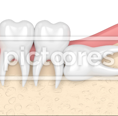 Teeth in gums with wisdom tooth horizontal impaction