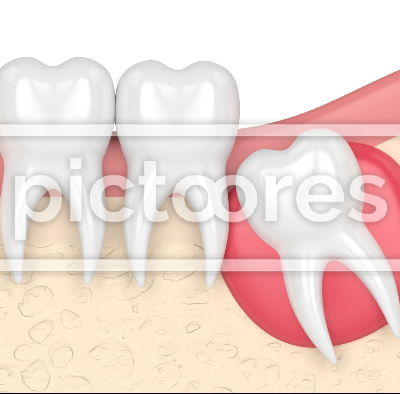 cyst, mesial, impaction, gingival, partial, eruption, tooth, teeth, wisdom, impact, gums, jaw, 3d, illustration, render, dental, dent, anatomy, destroy, damage, formation, oral, dentistry, dentition, disease, health, health care, molar, problem, root, unhealthy, angular, bone, damage, dental care, surgery, toothache, sore, ache, extraction, discomfort, medicine, medical, push, periodontal, swelling, inflammation, blockage, infection, toothing,