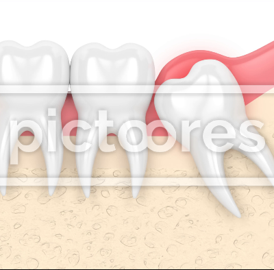 Wisdom mesial impaction with pericoronitis