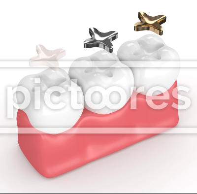 Teeth with different types of dental inlay filling