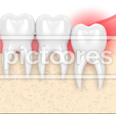 Wisdom vertical impaction causing pain