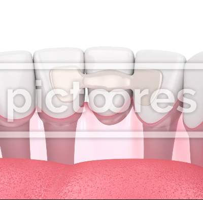 Lower jaw with dental maryland bridge placement