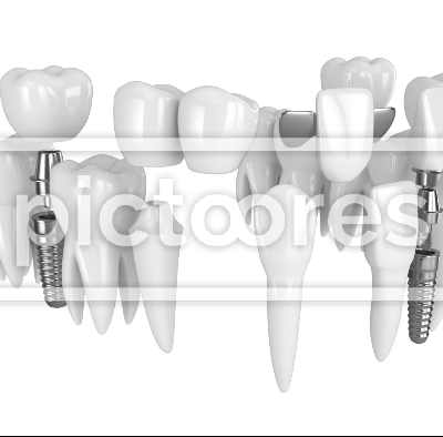 Toothing with different types of teeth rebuilding